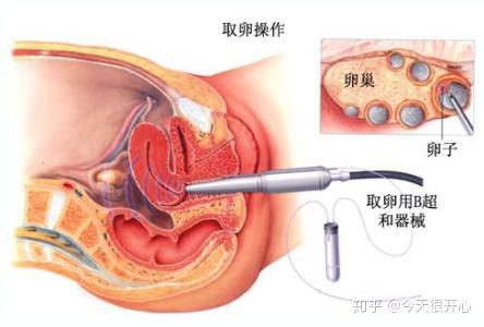 代生男孩的联系方式促排“新”药—+新型预充注射笔上市