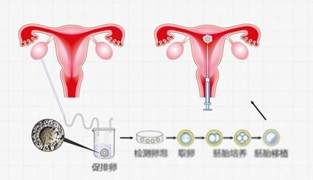 多囊卵巢综合症会不会怀孕呢多囊卵巢综合症可以针灸治疗吗.