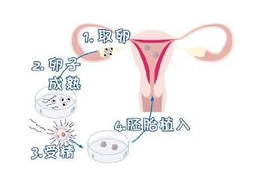 试管一超为什么是阴超+为什么试管大部分是龙凤